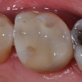 Wat is vochtbeheersing voor tandheelkunde?
