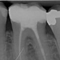 Waarom is vochtbeheersing vereist bij endodontische behandelingen?