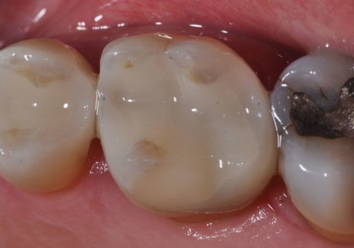 Wat is vochtbeheersing voor tandheelkunde?