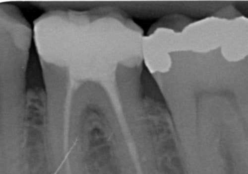 Waarom is vochtbeheersing vereist bij endodontische behandelingen?